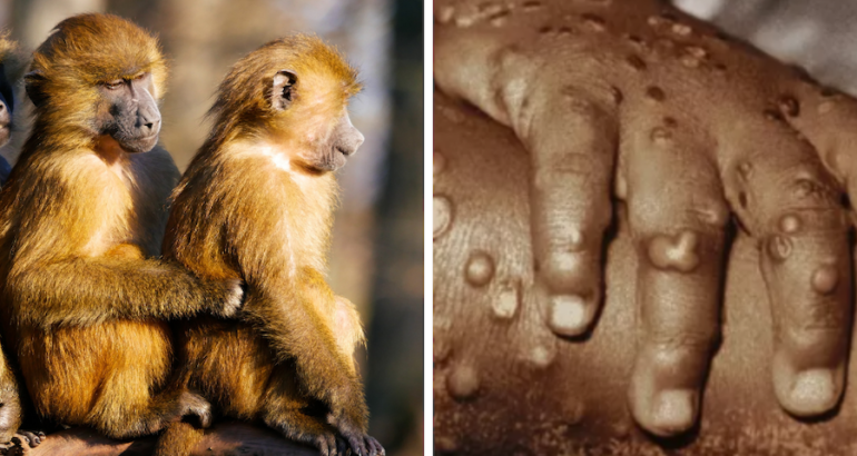 Autoridades detectan casos de viruela del mono en Norteamérica y Europa