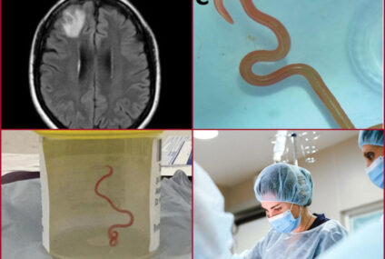 Investigadores encuentran por primera vez un gusano vivo en el cerebro de una mujer