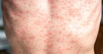 Brote de Sarampión en Chiapas: ¿Suspenden Posadas 2025, Fiestas de Navidad y Año Nuevo 2026?